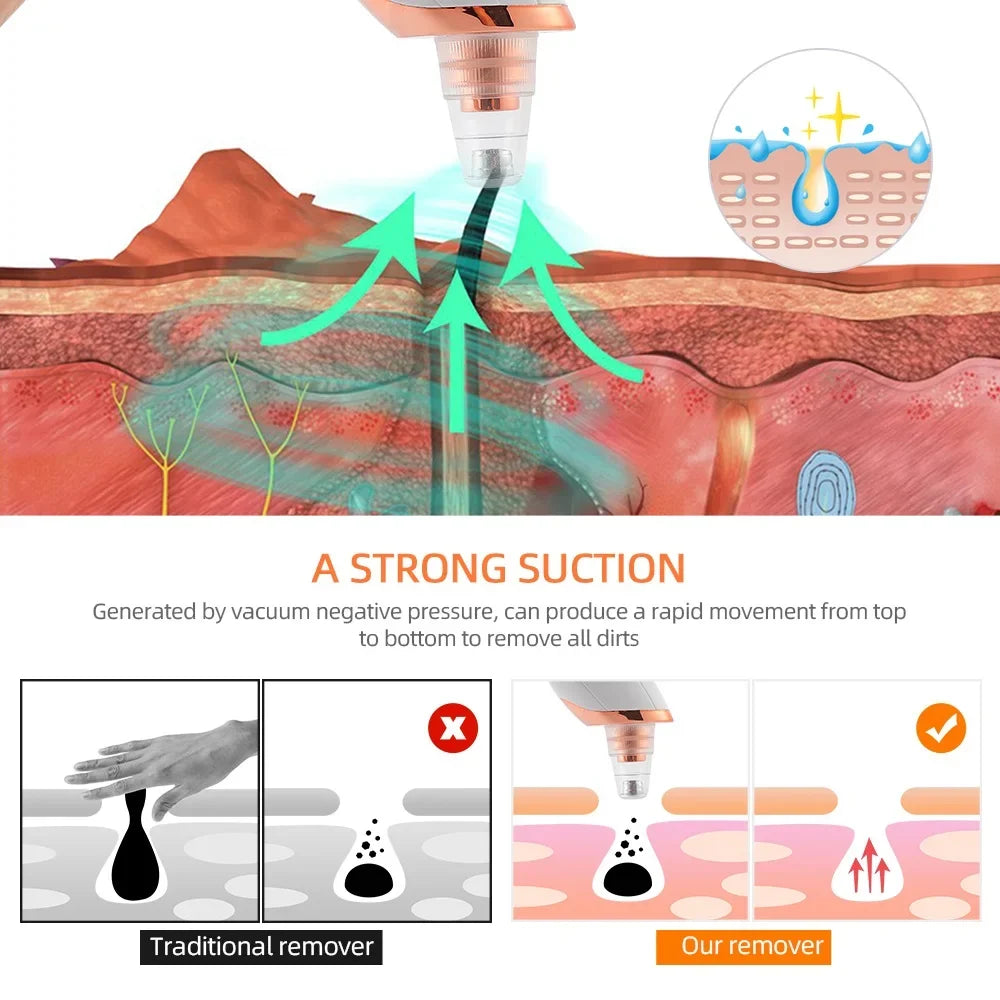 Aspirateur Points Noirs Visage